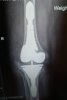 [Bonesmart.org] Right TKR revision from staph infection<