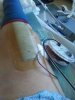 [Bonesmart.org] Right TKR revision from staph infection<