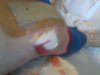 [Bonesmart.org] Right TKR revision from staph infection<