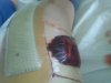 [Bonesmart.org] Right TKR revision from staph infection<