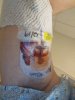 [Bonesmart.org] Right TKR revision from staph infection<