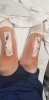 [Bonesmart.org] BTKR 28th May 2019 - post op journal