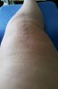 [Bonesmart.org] Lovetocookandsew’s long road to recovery