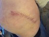 [Bonesmart.org] Jwadds Recovery (2 hip to be square!)