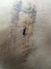 [Bonesmart.org] One woman, two hips , one week