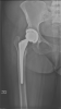 [Bonesmart.org] Trenna's recovery thread