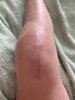[Bonesmart.org] Patella femoral recovery'