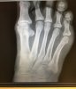[Bonesmart.org] Stress fracture right foot