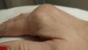 [Bonesmart.org] Finger joint replacement