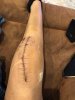 [Bonesmart.org] FitGal’s Recovery
