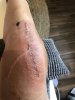 [Bonesmart.org] FitGal’s Recovery