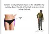 [Bonesmart.org] Bickypeg's new hip