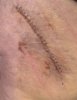 [Bonesmart.org] Hippies scars - post your badges of honor here: NO CHIT-CHAT HERE PLEASE