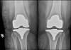 [Bonesmart.org] DLR recovery #2