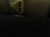 [Bonesmart.org] Swelling two years post op
