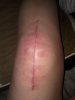 [Bonesmart.org] Hedie's recovery thread