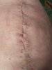 [Bonesmart.org] Carole’s recovery thread