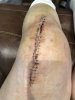[Bonesmart.org] Knee Scars - Post Your Badges of Honor Here! NO CHIT-CHAT please