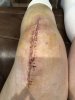 [Bonesmart.org] Knee Scars - Post Your Badges of Honor Here! NO CHIT-CHAT please