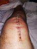[Bonesmart.org] Tykey's second knee replacement