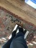 [Bonesmart.org] Total Ankle Replacement Journey