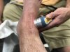 [Bonesmart.org] Total Ankle Replacement Journey
