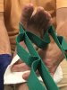 [Bonesmart.org] Total Ankle Replacement Journey