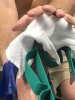 [Bonesmart.org] Total Ankle Replacement Journey