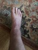 [Bonesmart.org] Total Ankle Replacement Journey