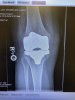 [Bonesmart.org] FitGal’s Recovery