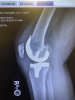 [Bonesmart.org] FitGal’s Recovery