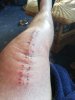 [Bonesmart.org] Tykey's second knee replacement