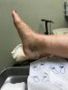 [Bonesmart.org] Total Ankle Replacement 9-12-19