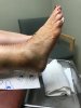 [Bonesmart.org] Total Ankle Replacement 9-12-19