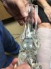 [Bonesmart.org] Total Ankle Replacement 9-12-19