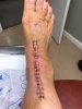 [Bonesmart.org] Total Ankle Replacement 9-12-19