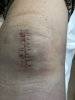 [Bonesmart.org] Millie's recovery thread