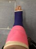 [Bonesmart.org] Millie's recovery thread