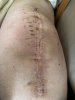 [Bonesmart.org] Knee Scars - Post Your Badges of Honor Here! NO CHIT-CHAT please