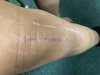 [Bonesmart.org] Knee Scars - Post Your Badges of Honor Here! NO CHIT-CHAT please
