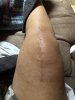 [Bonesmart.org] Knee Scars - Post Your Badges of Honor Here! NO CHIT-CHAT please
