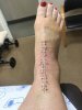 [Bonesmart.org] Total Ankle Replacement 9-12-19