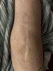 [Bonesmart.org] Knee Scars - Post Your Badges of Honor Here! NO CHIT-CHAT please