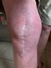[Bonesmart.org] Knee Scars - Post Your Badges of Honor Here! NO CHIT-CHAT please