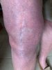 [Bonesmart.org] Knee Scars - Post Your Badges of Honor Here! NO CHIT-CHAT please