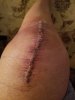[Bonesmart.org] Knee Scars - Post Your Badges of Honor Here! NO CHIT-CHAT please