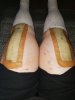 [Bonesmart.org] Knee Scars - Post Your Badges of Honor Here! NO CHIT-CHAT please