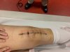 [Bonesmart.org] Knee Scars - Post Your Badges of Honor Here! NO CHIT-CHAT please