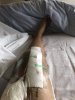 [Bonesmart.org] Kurt_H's Knee Infection