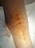 [Bonesmart.org] One Year Post Surgery